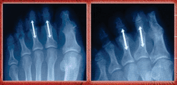 Imagen: El sistema de fusión digital  ARROW-LOK in situ (Fotografía cortesía de Arrowhead Medical Device Technologies).